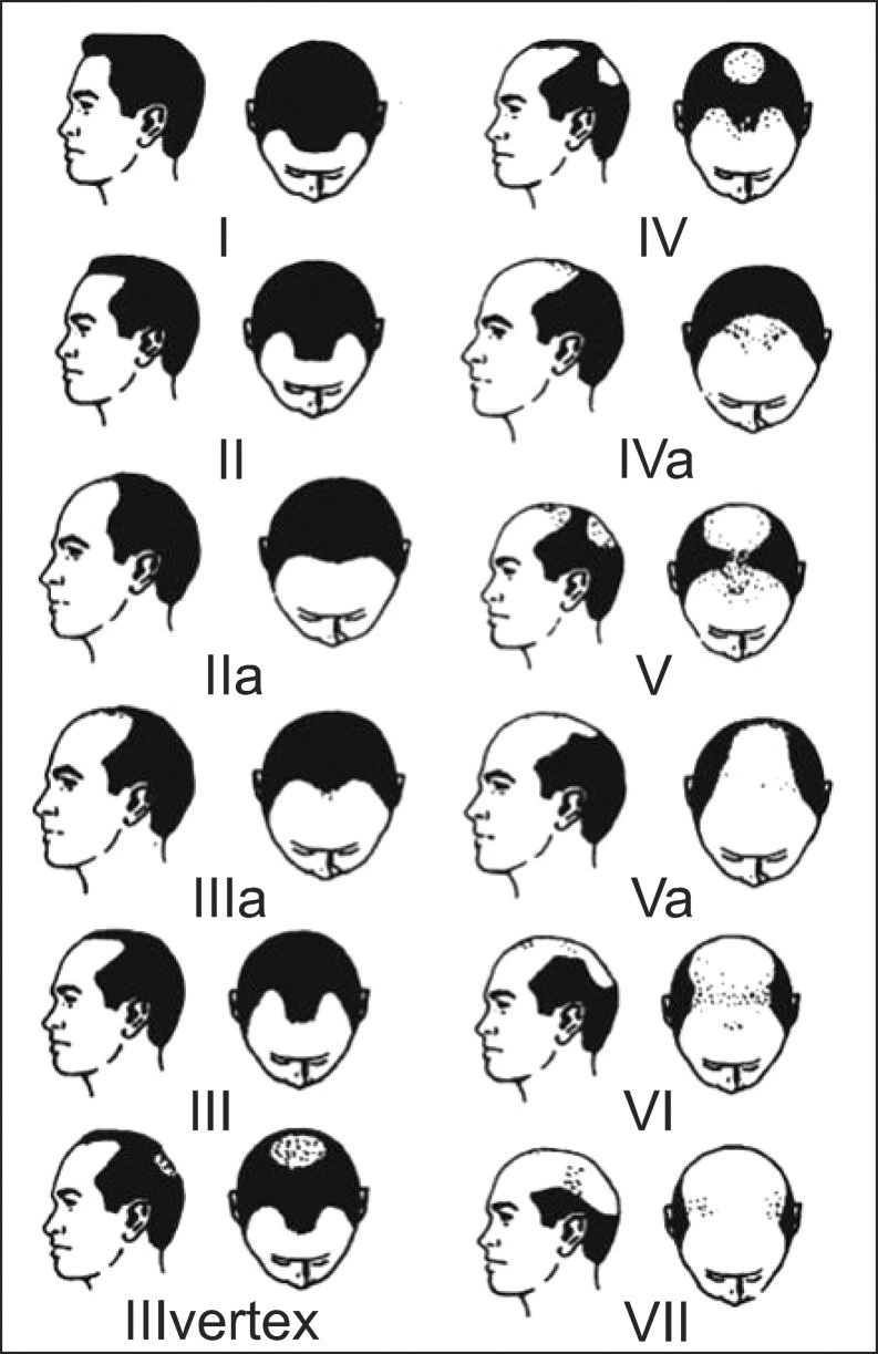 Norwood-Hamilton scale to broadly categorize male hair loss