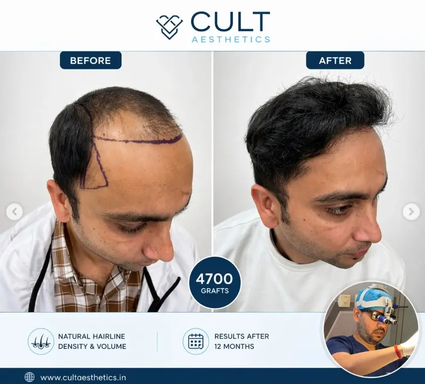 Hair transplant befroe after - Dr. Jaspreet Gulati - Dr. Jaspreet Gulati Hair transplant before and after results at Cult Aesthetics Dermatology, Sec 46 Gurgaon — natural-looking FUE/DHI outcomes by Dr. Jaspreet Gulati