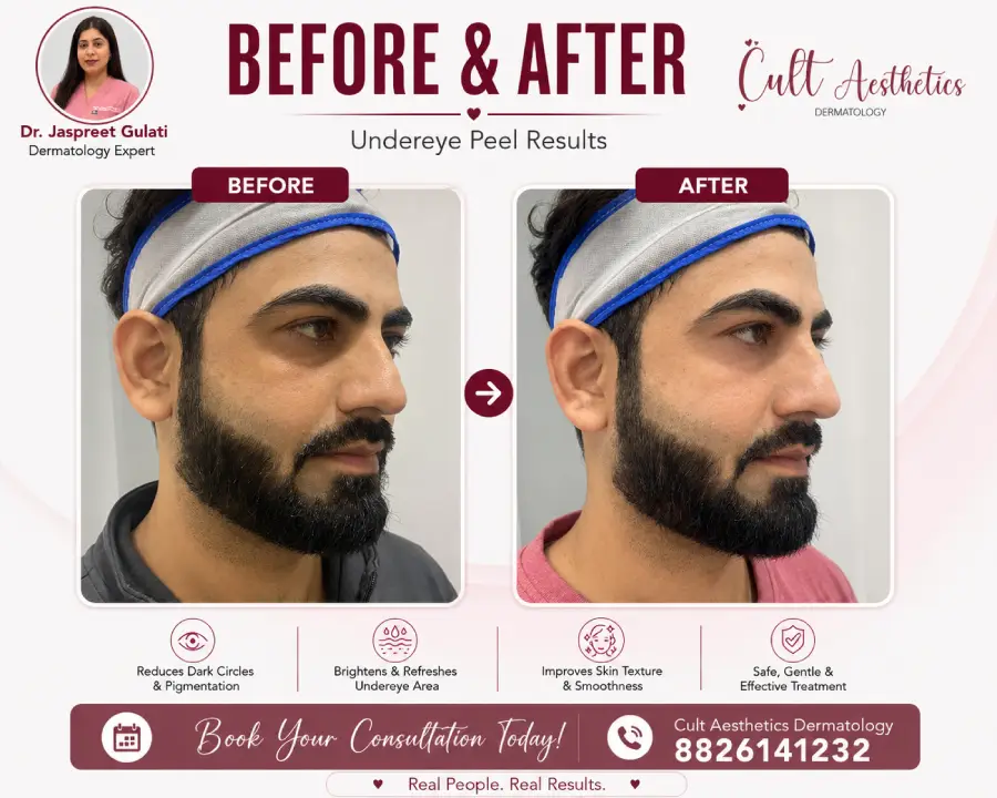 Hydrafacial Before after