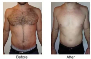 lhr-abdomen-chest-before-after-300x193