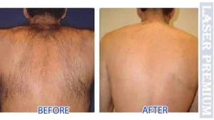 lhr-back-before-after-300x169
