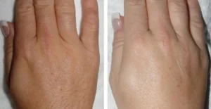 lhr-hands-before-after-300x155