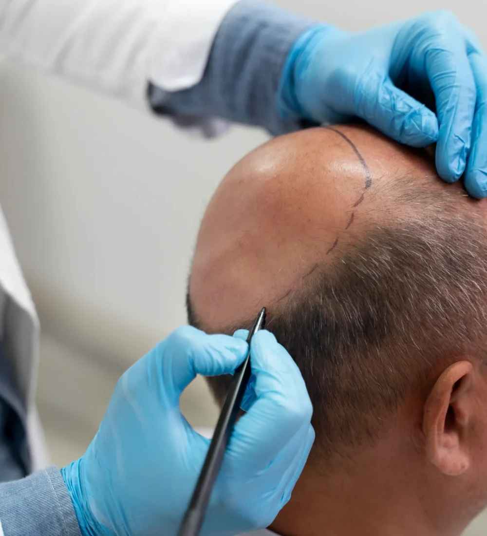 Hair Transplant